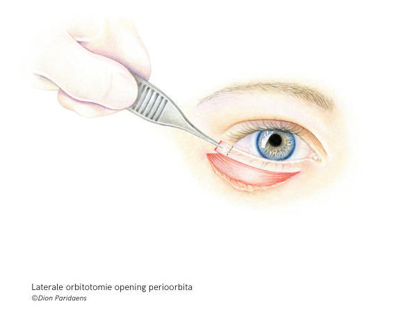 Laterale orbitotomie opening perioorbita ©Dion Paridaens