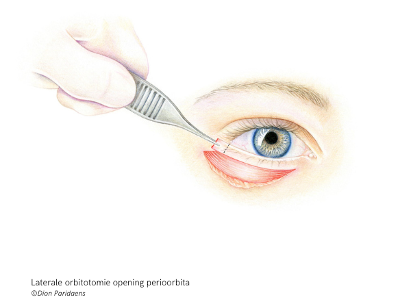 Laterale orbitotomie opening perioorbita ©Dion Paridaens Laterale orbitotomie opening perioorbita ©Dion Paridaens