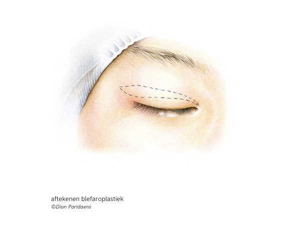 aftekenen blefaroplastiek ©Dion Paridaens