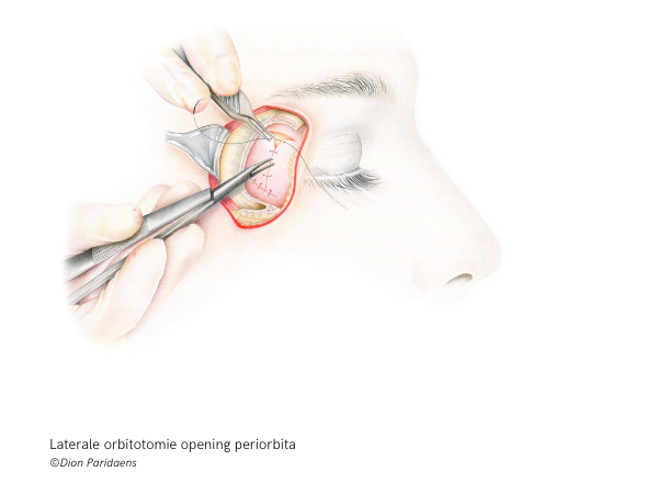 Laterale orbitotomie opening periorbita ©Dion Paridaens (1)